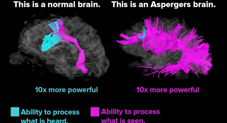 hjärna-Aspergers